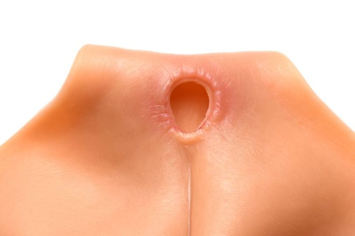 Vaginale tunnel